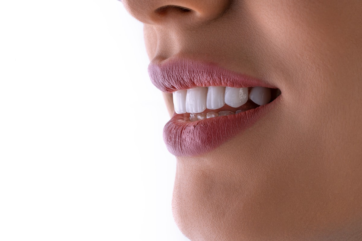 Best At-Home Whitening Kits